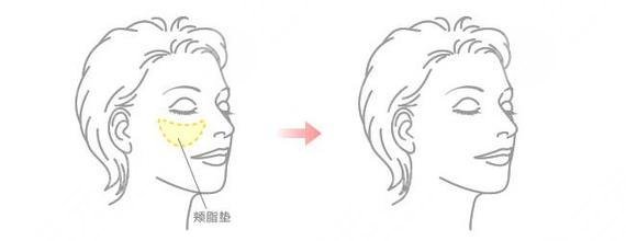 去颊脂垫有什么危害