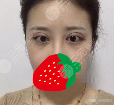 双眼皮修复案例