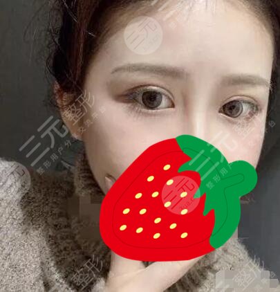 双眼皮修复案例