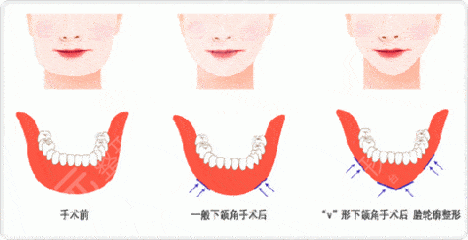 女性不对称下颌角整形手术原理
