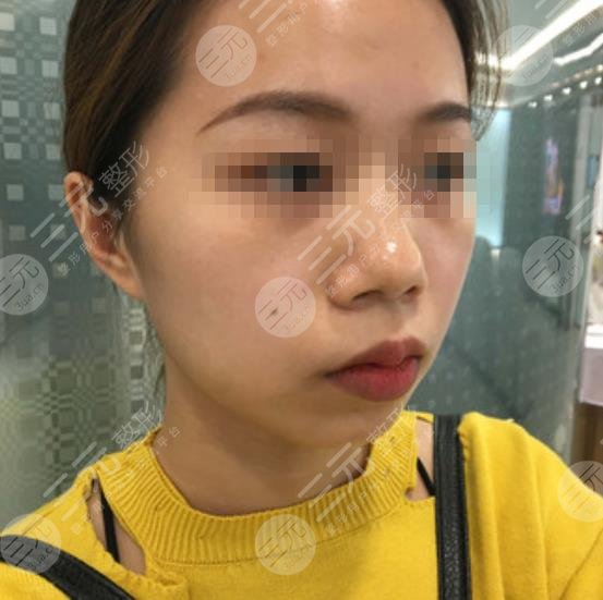 上海九院整形医院垫下巴案例
