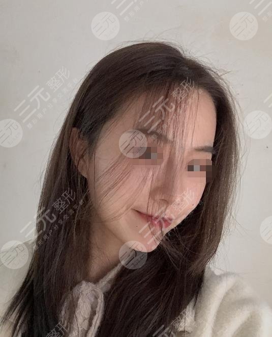 上海九院整形医院垫下巴案例
