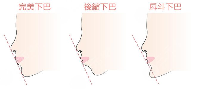脂肪隆下巴多少钱