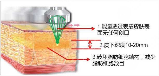 光纤溶脂瘦小腿