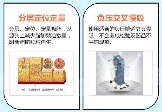 光纤溶脂瘦小腿手术优点