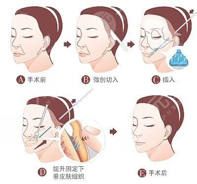 手术原理
