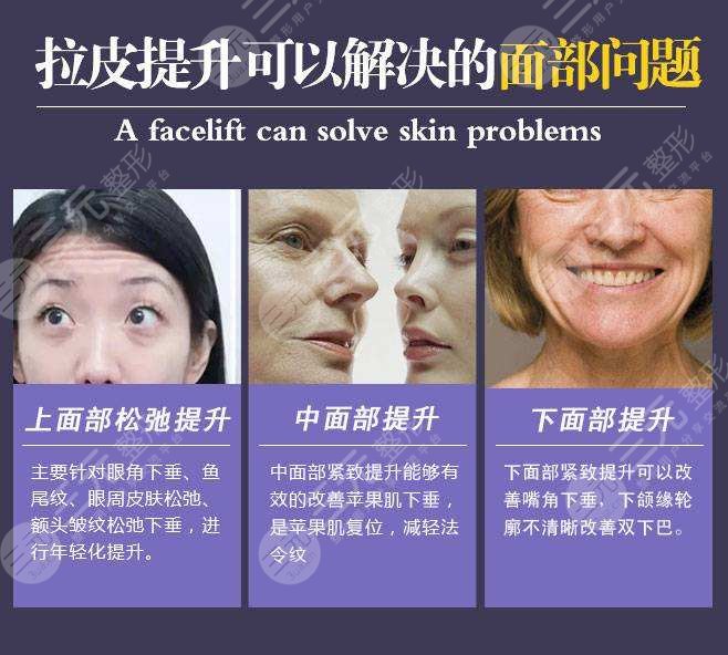 除皱手术优点