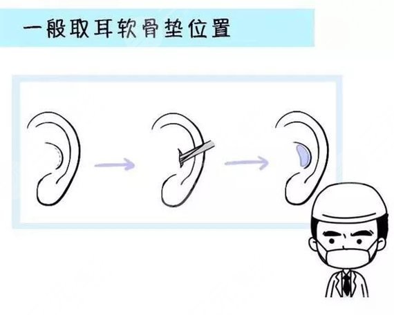 自体耳软骨隆鼻科普