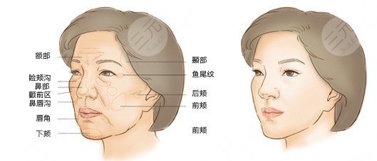 自体脂肪填充法令纹能保持多久呢