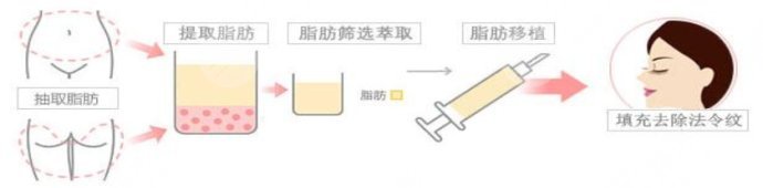 自体脂肪填充法令纹果怎么样
