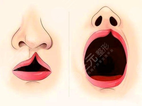 小儿兔唇整形什么年龄好?