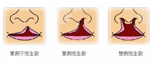 小儿兔唇整形注意事项