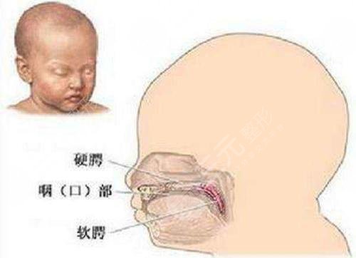 小儿兔唇整形什么年龄好?