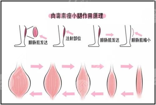 注射瘦腿的优势: