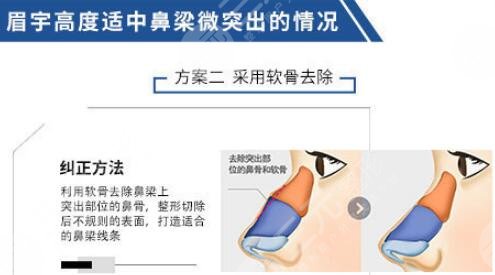 驼峰鼻整形手术