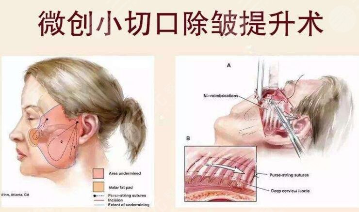 手术简介