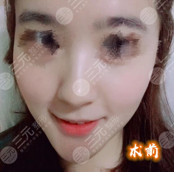 塌鼻子的救星