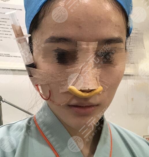 塌鼻子的救星 肋软骨隆鼻