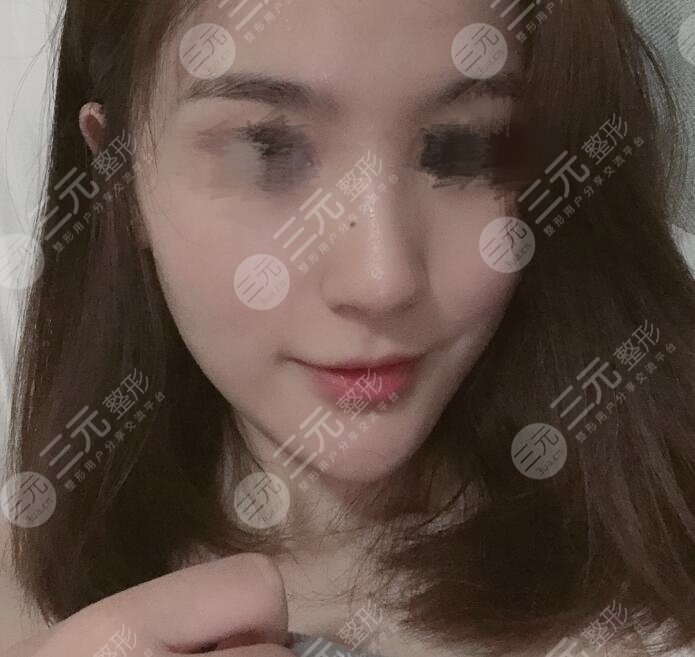 隆鼻术后果图