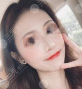 硅胶隆鼻前后对比果图一览，假体也能做出洋气美鼻！
