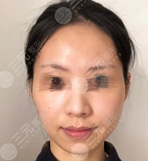 隆鼻之前