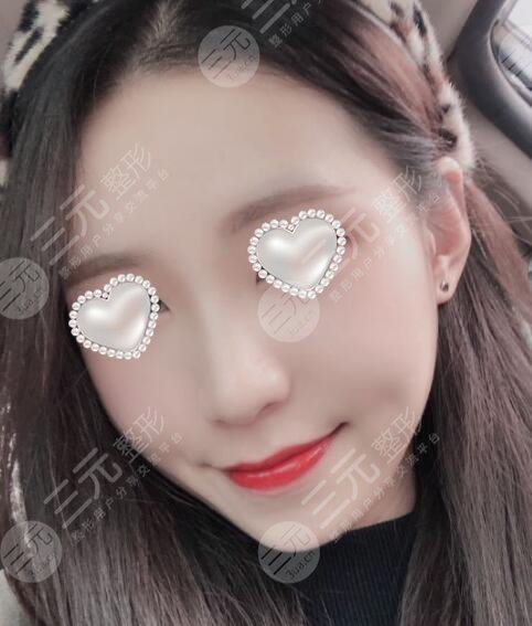 硅胶隆鼻前后对比