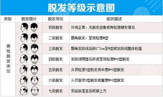头顶植发