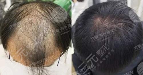 头顶植发果
