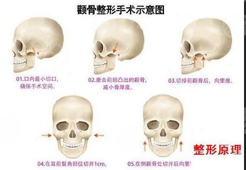 瘦脸整形颧骨手术