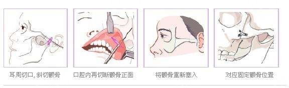 手术过程