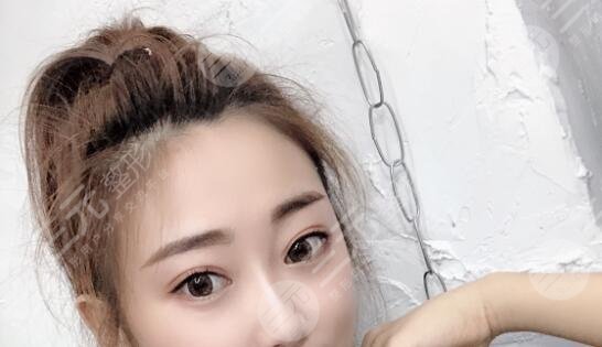 双眼皮手术案例反馈后