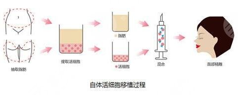 面部填充手术果