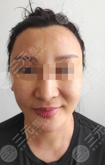 电波拉皮除皱术案例前