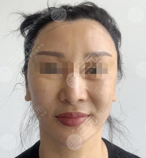 电波拉皮除皱术案例后