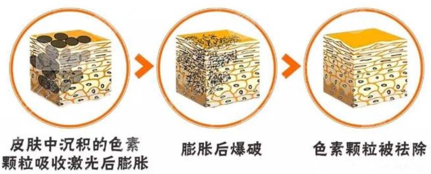 激光去老年斑原理