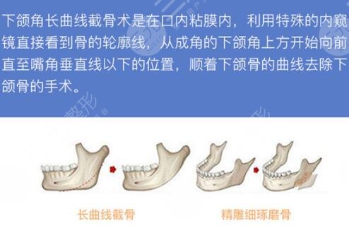 下颌骨截角手术原理