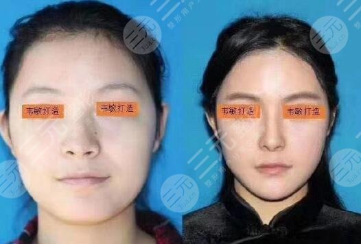 下颌骨截角手术果
