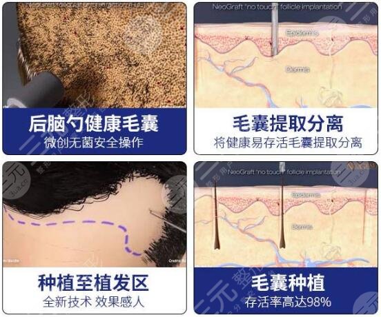 植发技术的优势