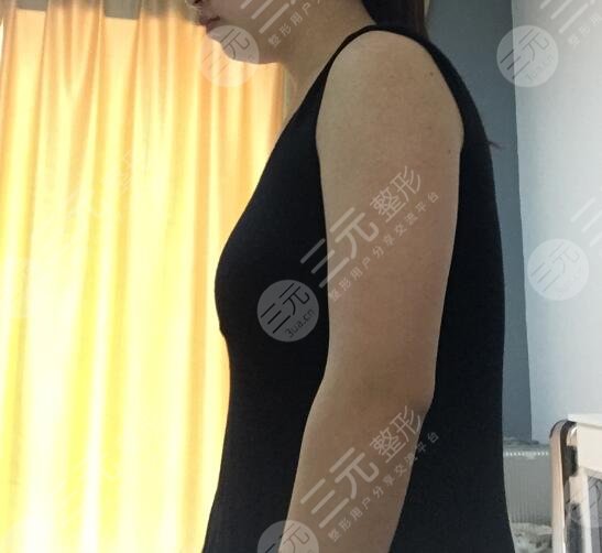 假体隆胸案例前