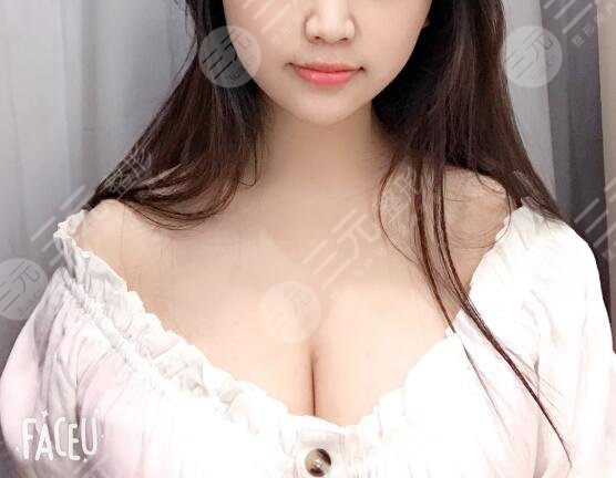 假体隆胸案例后2个月