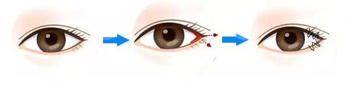 开眼角外眼角手术一般要注意哪些?
