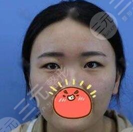 开外眼角案例前