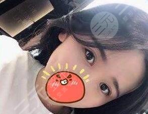 开外眼角案例后