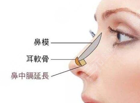 进口膨体隆鼻一般要多少钱?