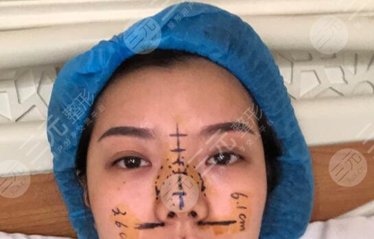 进口膨体隆鼻案例前