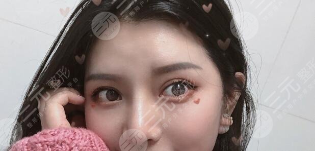 进口膨体隆鼻案例后