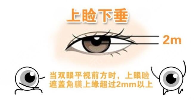 上睑下垂手术有风险吗?如何避免风险呢?