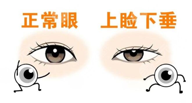 上睑下垂手术有风险吗?如何避免风险呢?