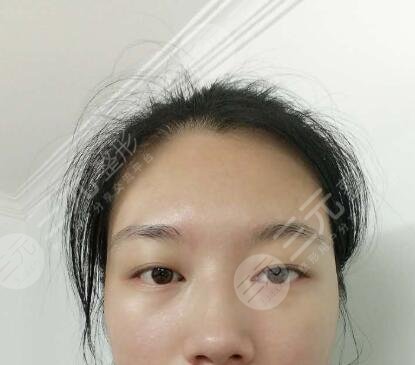 上睑下垂矫正案例前