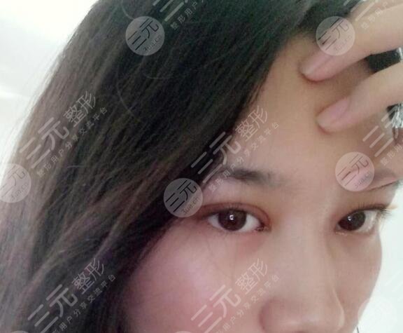 上睑下垂矫正案例后